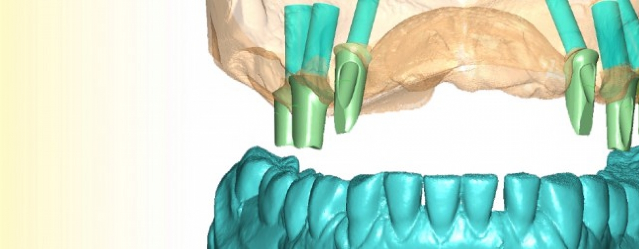 IMPLANTATE